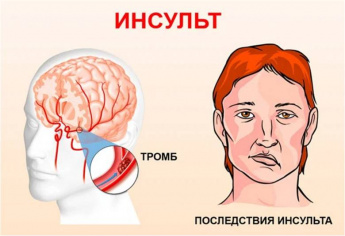Неделя борьбы с инсультом: знания, которые могут спасти жизнь
